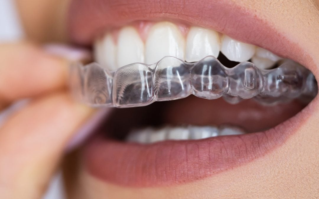 ClearCorrect® Aligner
